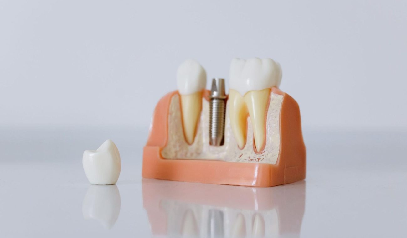 Why Consider Dental Implant Surgery for Missing Teeth
